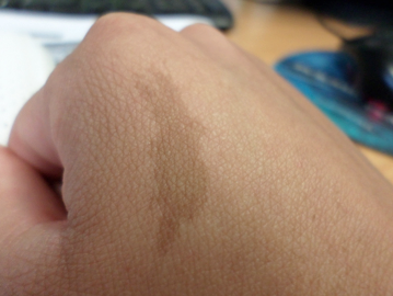 Birthmarks on the hand