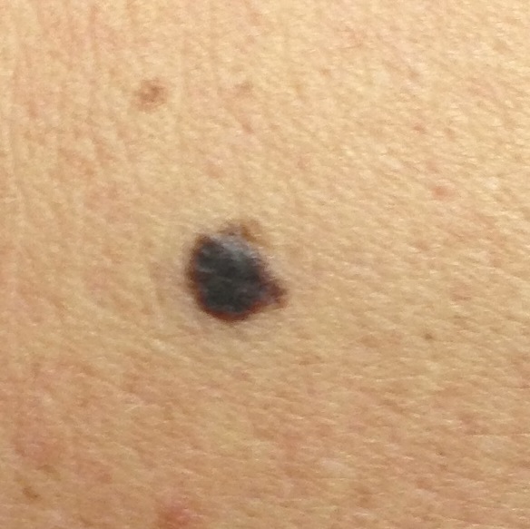 Melanoma on upper arm left