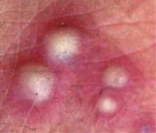 Skin lesion pictures: Pustules | SkinVision Library